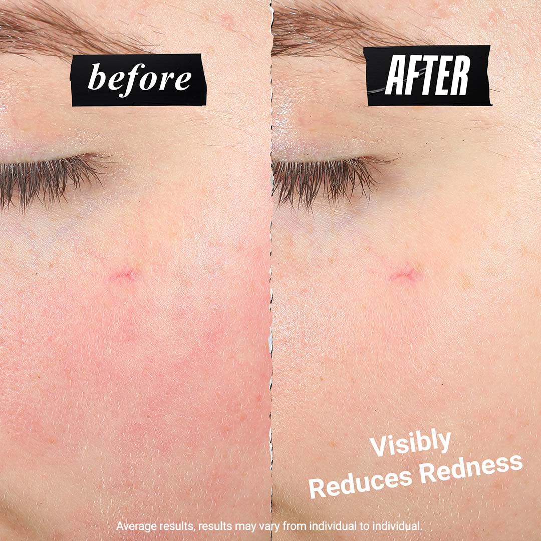 Before and after close‑up of cheek showing reduced redness after using Ultra Facial Meltdown Recovery Cream	