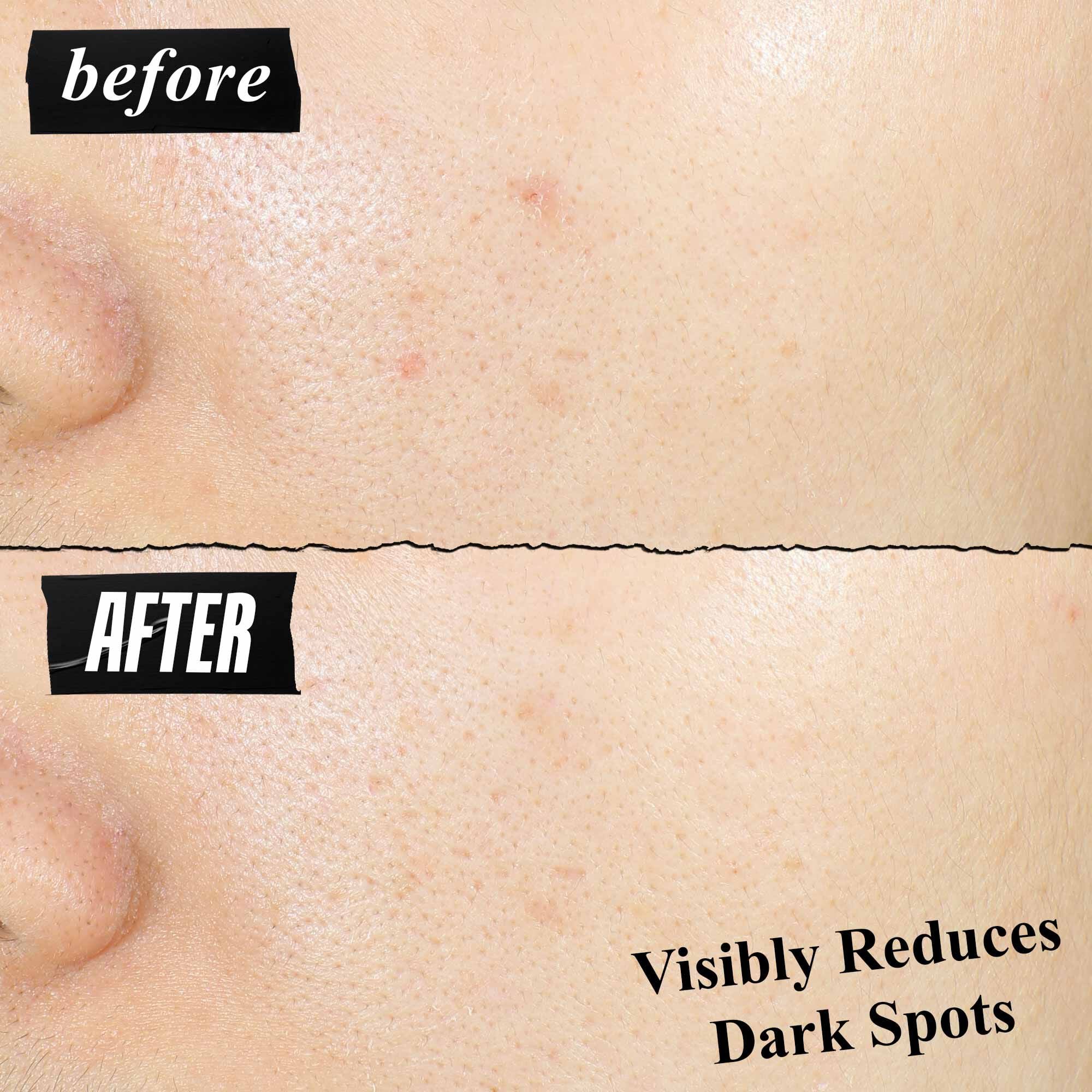 Clearly Corrective™ Dark Spot Solution