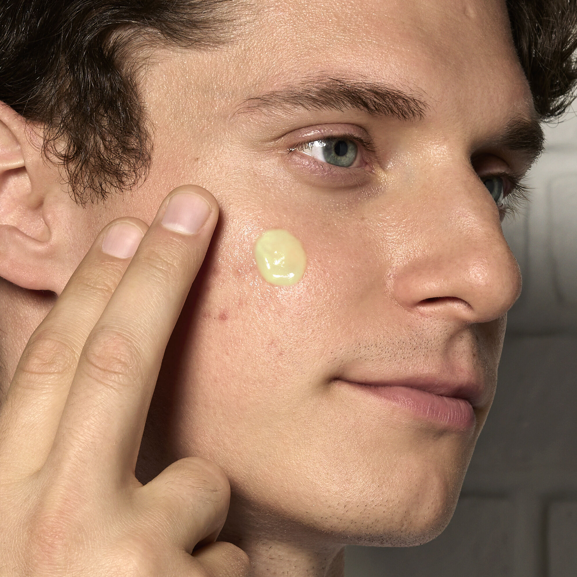 How to Prevent Acne and Manage Acne Pigmentation 