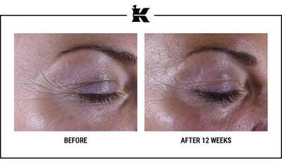Before and After Super Multi-Corrective Eye Zone Treatment